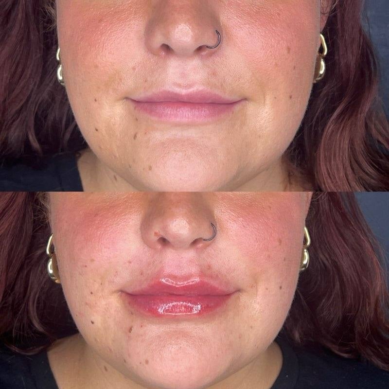 Lip Flip and lip filler results